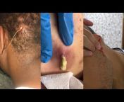 Pimple Popping And Cyst Removal Paradise