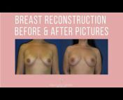 PRMA Plastic Surgery &#124; Center For Advanced Breast Reconstruction