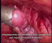 Ενημερωτικό βίντεο λαπαροσκοπικής σκωληκοειδεκτομής, εξαιτίας οξείας σκωληκοειδίτιδας σε οπισθοτυφλική θέση. Η χειρουργική επέμβαση διεξήχθη από τον χειρουργό Γιώργο Τσιλεδάκη στην Κεντρική Κλινική Τσεπέτη http://chaniaclinic.com/. Στο βίντεο περιγράφονται τα βασικά βήματα της ε