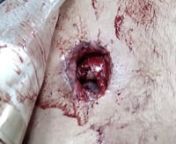 sucking chest wound from sucking