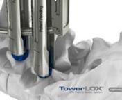 TowerLOX MIS Pedicle Screw System delivers efficient, accurate, and less invasive rod insertion.More details about TowerLOX can be found at captivaspine.com/towerlox.nnAbout PivoQuik™:nPivoQuik inserter is intended to reduce tissue dissection typically required in larger patients. The inserter provides simple and quick rod angle adjustments and effortless attachment and release from the rod. A visual insertion gauge provides surgeon a prompt for rod articulation. nnAlso featured in this vide