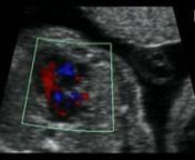 Tricuspid atresia with VSD at 22 weeks from vsd