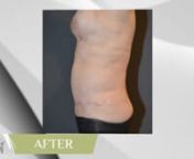 Abdominoplasty or tummy tuck is the surgical removal of excess skin and fat in the abdomen, tightening of the underlying rectus muscle and repositioning of the umbilicus to create a flat stomach and desirable contour of the hips and waist.nnLearn more - http://www.artisteplasticsurgery.com.au/procedures/abdominoplasty-tummy-tuck/
