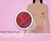 Taking its name from the transverse rectus abdominus muscle, the TRAM flap is a surgical procedure that uses muscle, fat and skin from the lower abdomen. First developed in the early 1980s, it is one of the first reconstruction procedures to perfect the use of tissue from the woman’s own body.nnBecause the TRAM procedure removes skin and fatty tissue from the abdomen and transfers it to the chest, a benefit of the surgery is a tightening of the skin over the abdomen with results similar to a t