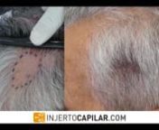 Paciente de 66 años, presenta dos lesiones laterales simétricas en área temporoparietal, que él recuerda como causa del parto. La alopecia triangular congénita (ATC), es una alopecia circunscrita no cicatricial que suele localizarse en área fronto temporal, de manera unilateral, aunque también existen, como esta, formas bilaterales. Se trata de una hipoplasia de los folículos pilósos en el área sin otras alteraciones significativas. La causa de la afección es desconocida. Su diagnóst
