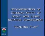 Dr Stephan Ariyan - RECONSTRUCTION OF SURGICAL DEFECT OF SCALP WITH LARGE ROTATION ADVANCEMENT \ from ariyan