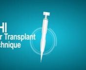 Clínica de Transplante Capilar Dr. Serkan AYGIN &#124; F.U.E. &#124; DHi Transplante capilar &#124; Transplante capilar na TurquiannDHI implanter pen selection based on patient specificationsnFirst StepnExtraction of hair follicles from the donor sitenSecond StepnPlacement of hair follicles into the DHI implanter pennThird StepnPlacement at the right angle and direction to provide natural resultsnFourth StepnHair follicles are implanted with total precisionnn0090 555 100 40 40 (Whatsapp)nndrserkanaygin.com/ha