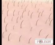 Bu 3 boyutlu animasyonu izleyerek, nanoteknolojik Folixir ürünlerinin saç dökülmesini nasıl engellediği ve yeni ve sağlıklı saç gelişimini başlattığı hakkında detaylı bilgi sahibi olacaksınız. (Prof. Dr. Meral Şaşoğlu - Folixir)