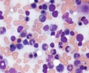 Only 27 percent of patients with acute myeloid leukemia live at least 5 years after the cancer is found. UT Southwestern Medical Center is working to change that, as one of only 11 sites in the U.S. selected for Beat AML, a master clinical trial using a precision medicine approach to destroy the disease.