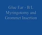 myringotomy-grommet-insertion-for-otitis-media-with-effusion-ome-glue-ear-givefastlink.mp4 from otitis media with effusion ome