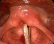 Watch a video of the same vocal cord paralysis after repair. Note the gap is eliminated.