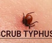 20211122_Scrub Typhus in Children from typhus scrub