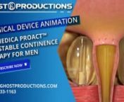 Ghost Productions medical animation studio produced for Uromedica a medical device marketing piece that highlights the ProACT. nThis 3D medical animation was created to help market Uromedica ProACT™:Adjustable Continence Therapy for Men. This surgical implant helps patients who suffer from urinary incontinence to live fuller lives. Urinary incontinence can result from many causes. Physiological causes can be classified as either bladder dysfunction or urethral sphincter incompetence and may