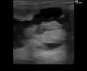 Ultrasound clip taken with a GE Logiq e. It shows a Equine 72 Day Pregnancy. nnThis image is provided by BCF Technology.nnTo learn more go to www.bcftechnology.com