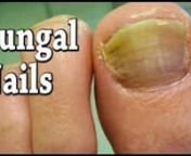 Fungal Toenails - Podiatrist, foot Doctor of Podiatric Medicine, Foot Specialist, Toronto, ONnnPodiatrist Sheldon Nadal discusses the symptoms, causes and treatments for Fungal Toenailsnwww.footcare.netnnNail FungusnnMany people don&#39;t realize they have a fungal nail problem and, therefore, don&#39;t seek treatment. Yet, fungal toenail infections are a common foot health problem and can persist for years without ever causing pain. The disease, characterized by a change in a toenail&#39;s color, is often