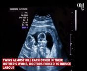 Twins almost kill each other in their mother's womb, doctors forced to induce labour from forced physics llc