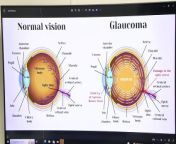 With glaucoma being the leading cause of blindness in Trinidad and Tobago,on this world glaucoma week, the main message to at-risk groups is, &#92;