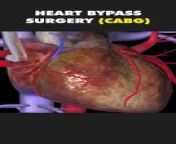 Heart Bypass Surgery 3D Animation (CABG)&#60;br/&#62;#cabg #coronaryarterybypassgraft #coronaryarterydisease #heartbypasssurgery #heartsurgery #heartsurgerysurvivor #coronaryarterybypassgraftsurgery #coronarydisease #medical3danimation #3dmedicalanimation